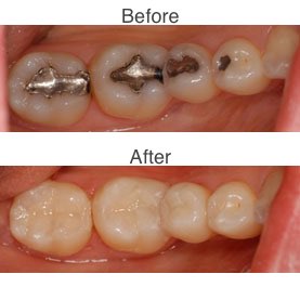 Amalgam Fillings vs.Composite Fillings before and after